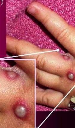 فيروس قاتل جديد يهدد البشر و رعب كبير من انتشاره