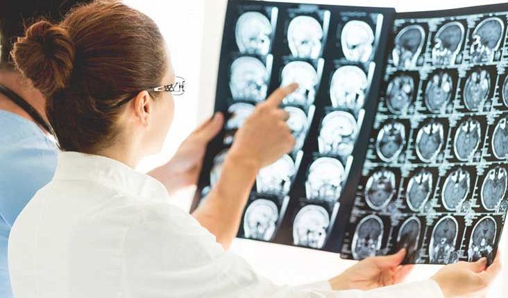 اختراق جديد في تشخيص مرض ألزهايمر بإختبار دم دقيق بنسبة 90%